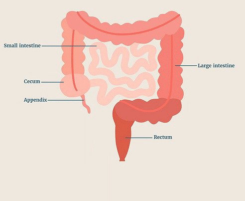 chronic appendicitis illustration showing long term inflammation of appendix with abdominal pain