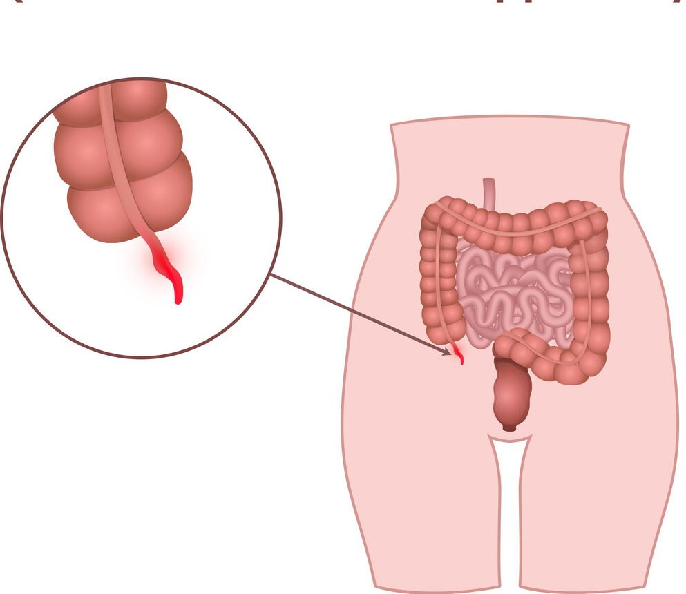 Appendicitis medical illustration showing appendix surgery treatment by Dr Parul Garg laparoscopic surgeon in Mohali