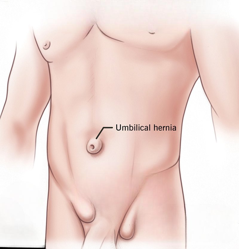 Umbilical hernia swelling near belly button treated by laparoscopic hernia surgeon Dr Parul Garg