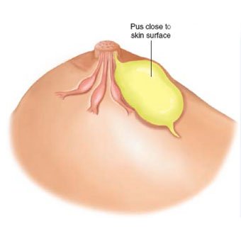 Microdochectomy breast surgery illustration showing removal of a milk duct by Dr Parul Garg female surgeon in Mohali for patients from Srinagar Jammu Kashmir