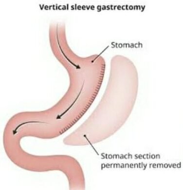Bariatric weight loss surgery treatment by Dr Parul Garg robotic and laparoscopic surgeon in Mohali for patients from Srinagar and Chandigarh